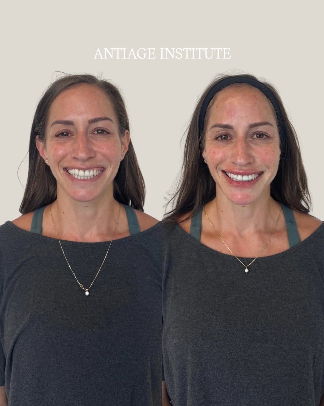 Instagram post by Dr. Richard H. LeConey: Facial balancing, not facial changing. Small, strategic adjustments can make a meaningful difference when the goal is to bring the features …