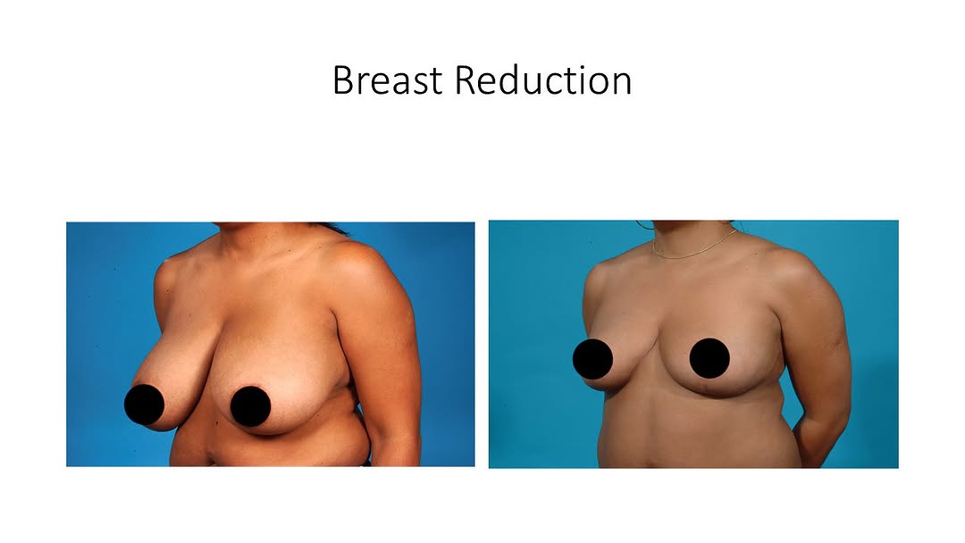 Instagram post by Dr. Richard Ha: Breast reduction isn’t just about going smaller. For many women, it’s about feeling more comfortable in their body and in everyday life. Top…