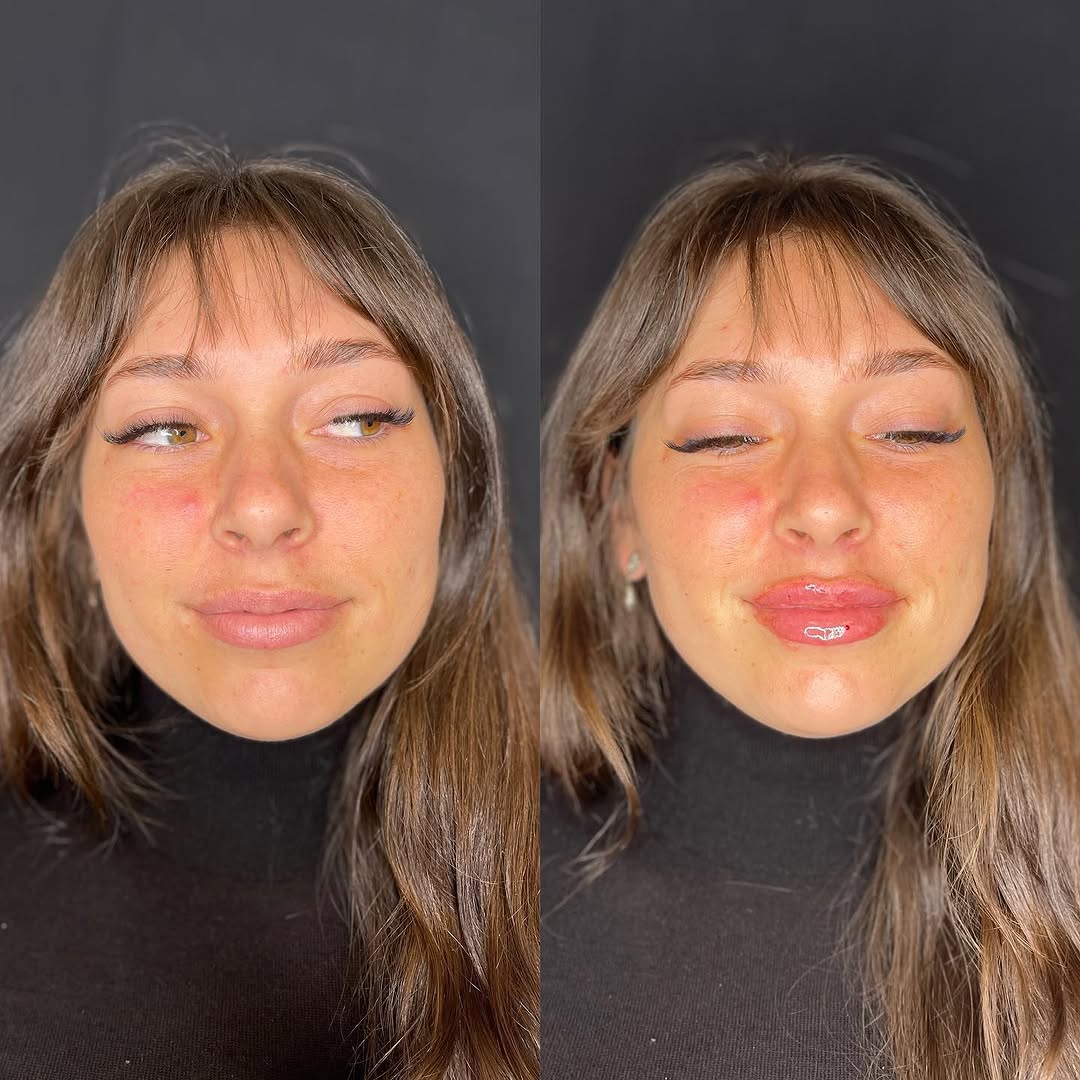 Instagram post by Dr. Richard J. Brown: That fresh lip feeling 😍 This beauty came back in for a 2nd syringe of Restylane Kysse.💉 👄There’s one week left to secure $100 off lip fi…