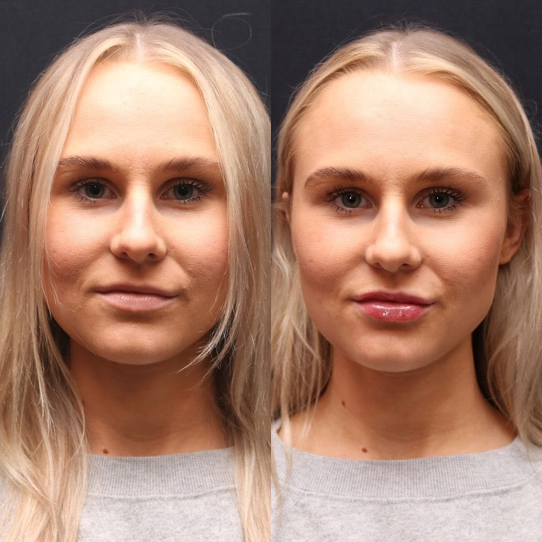 Instagram post by Dr. Richard J. Brown: 1 syringe of @juvederm Ultra for this beauty!💋 If you book a service for February, you’ll be entered to win a free syringe of lip filler 💉…