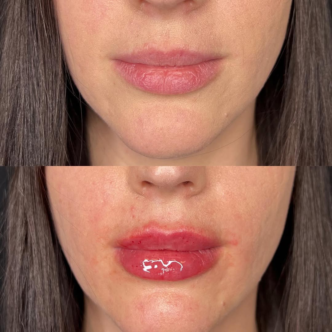 Instagram post by Dr. Richard J. Brown: February is for lips!💋 Here are our current specials: 💌$100 off lip filler 💌40% off @juvederm Volbella (perfect for a very subtle lip enh…