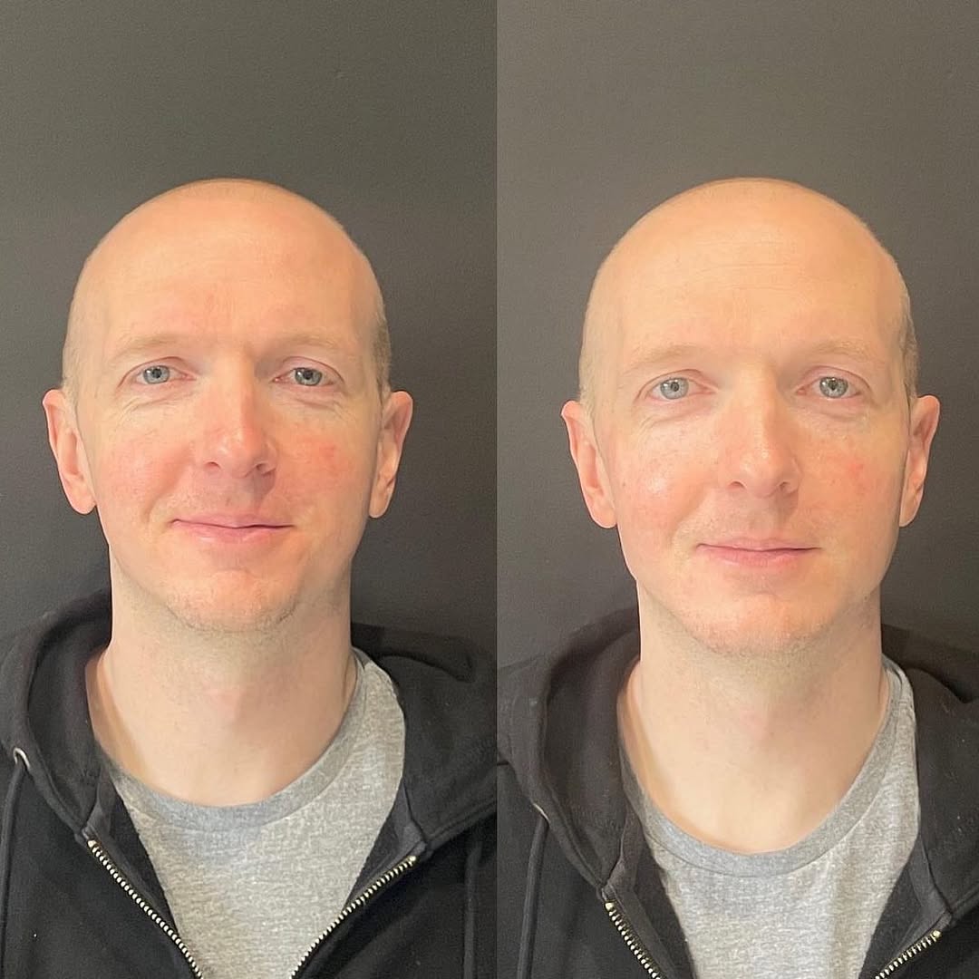 Instagram post by Dr. Richard J. Brown: New jawline, cheeks, and chin by @aesthetics_bymirandarn 😍💉 Miranda used 6 syringes Juvéderm Volux & 4 syringes of Voluma on this patient.…