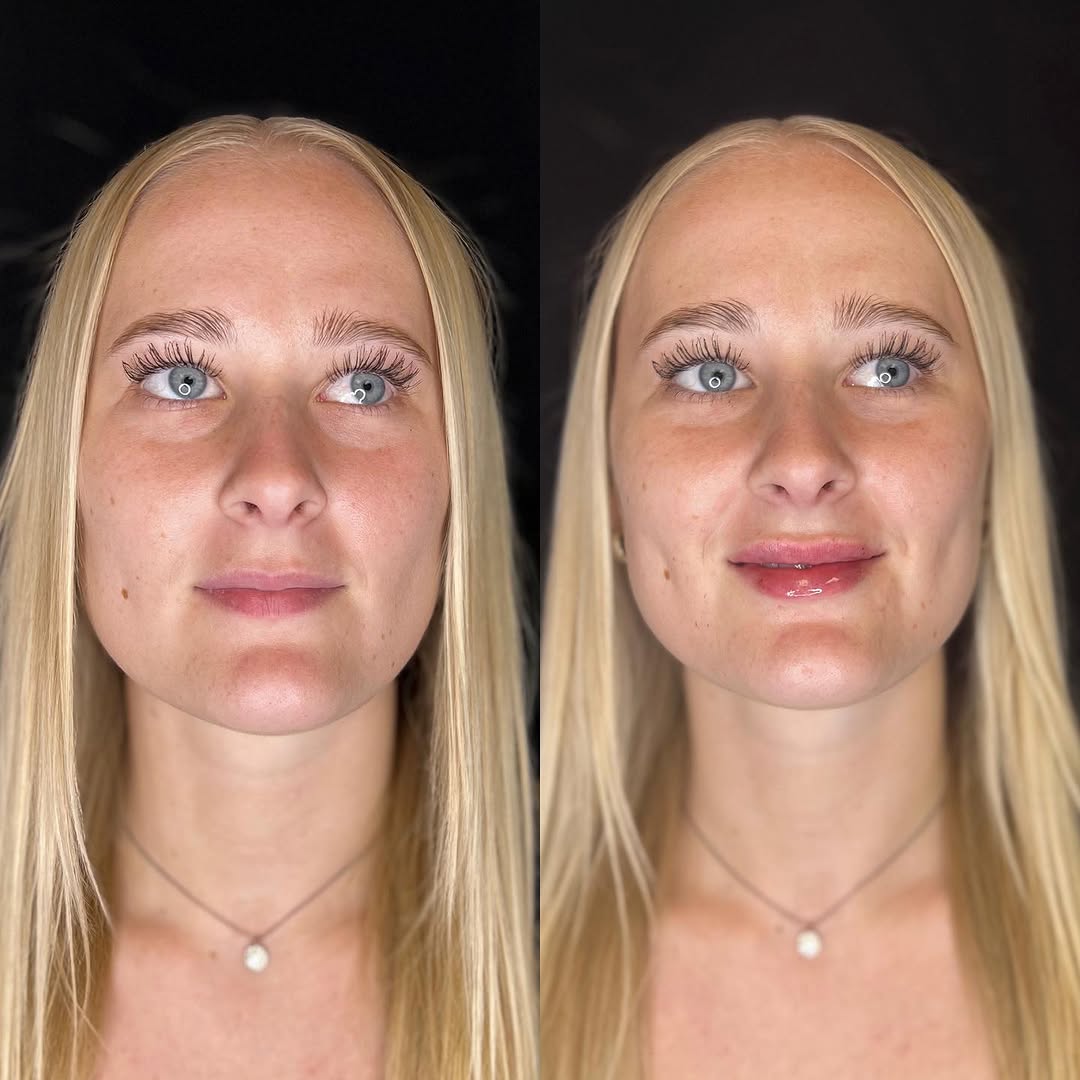 Instagram post by Dr. Richard J. Brown: The perfect amount of plump 👄 Save $200 on filler THIS MONTH ONLY! @aesthetics_bymirandarn did 1 syringe of Restylane on this beauty 🫶🏼 S…