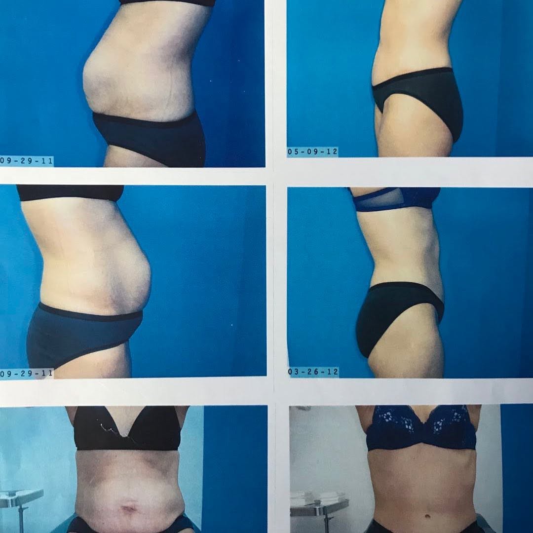 Instagram post by Dr. Richard J. Lung: Before and after tummy tuck 3054314579 #abs #tummy #miami #perfectabs #plasticsurgery #cosmetology #cosmeticsurgery