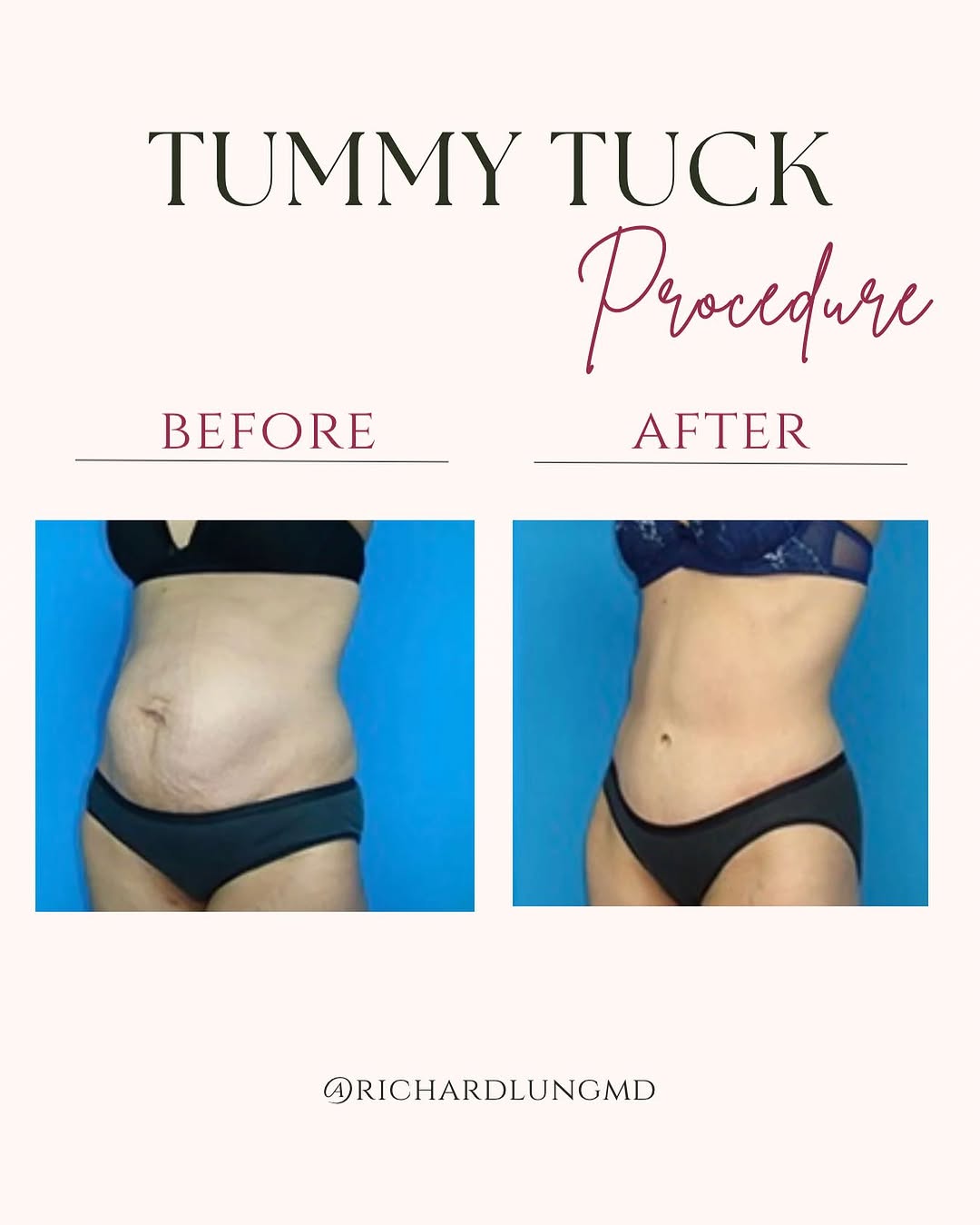 Instagram post by Dr. Richard J. Lung: Another patient with fantastic Tummy Tuck results! If you desire results like this don’t hesitate and contact me for a Consultation! ☎️ 305-…