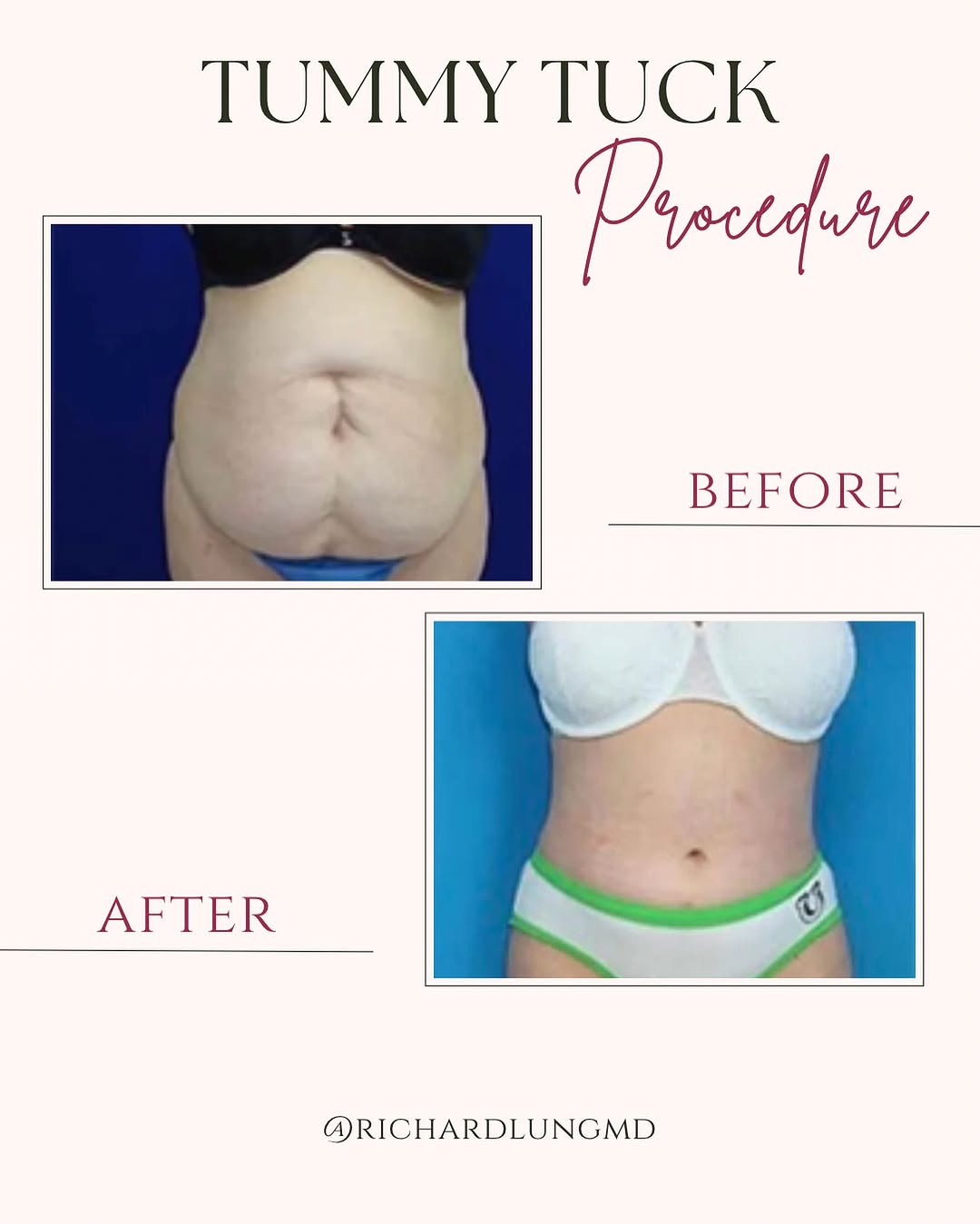 Instagram post by Dr. Richard J. Lung: Achieve your Dream Summer Beach Body with our Tummy Tuck procedure. Call or Dm for a Consultation ☎️ 305-431-4579