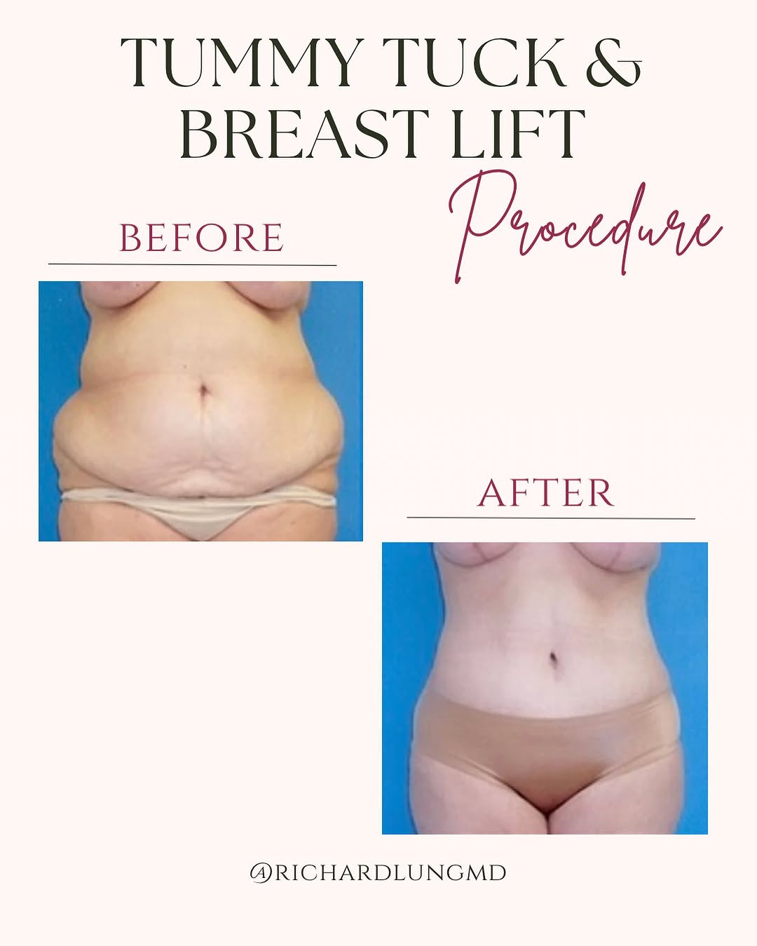 Instagram post by Dr. Richard J. Lung: Check out these fantastic Tummy tuck and Breast lift results! We snatched her waist with a tummy tuck and lifted her breasts for her dream b…