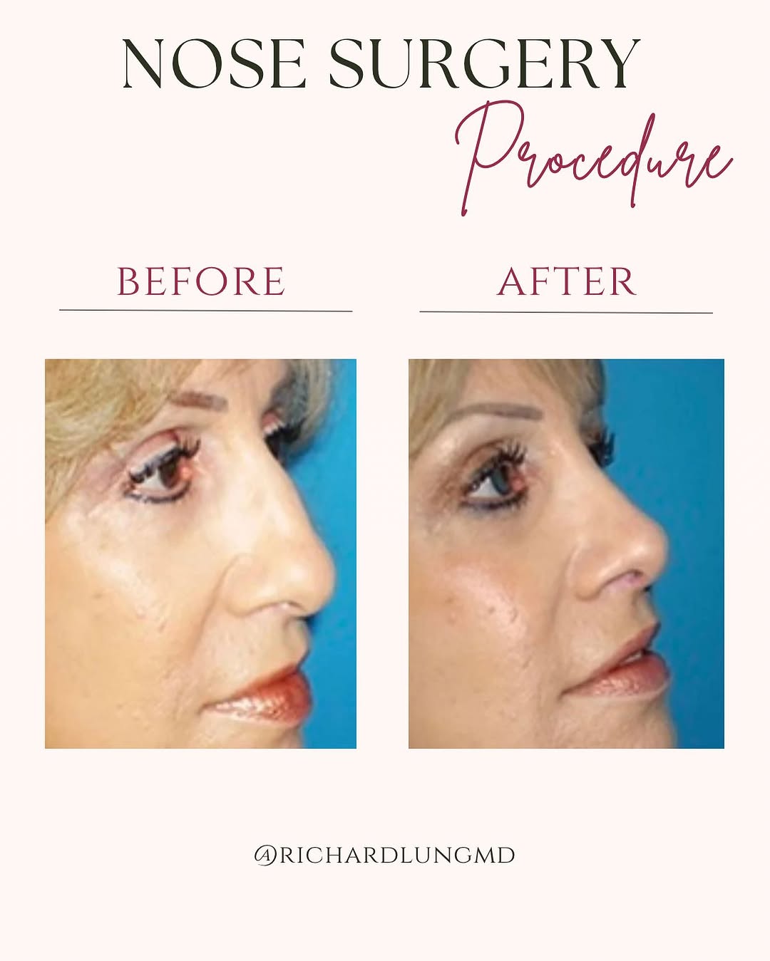 Instagram post by Dr. Richard J. Lung: Check out these amazing Nose Surgery Results! If you desire these results don’t hesitate and contact us for a consultation! ☎️ 305-431-4579 …