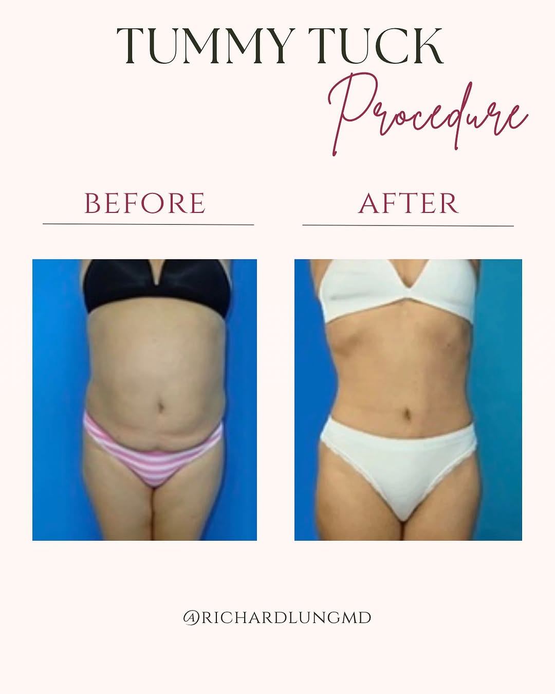 Instagram post by Dr. Richard J. Lung: Another patient with transforming Tummy tuck results! If you desire these results don’t hesitate and contact us for a consultation! ☎️ 305-4…