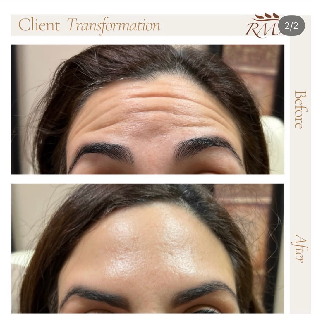 Instagram post by Dr. Richard Junke: Discover the transformative benefits of Dysport/Botox by our Physician Injector, Dr. Junke and rejuvenate your skin like never before! ✨Smoo…