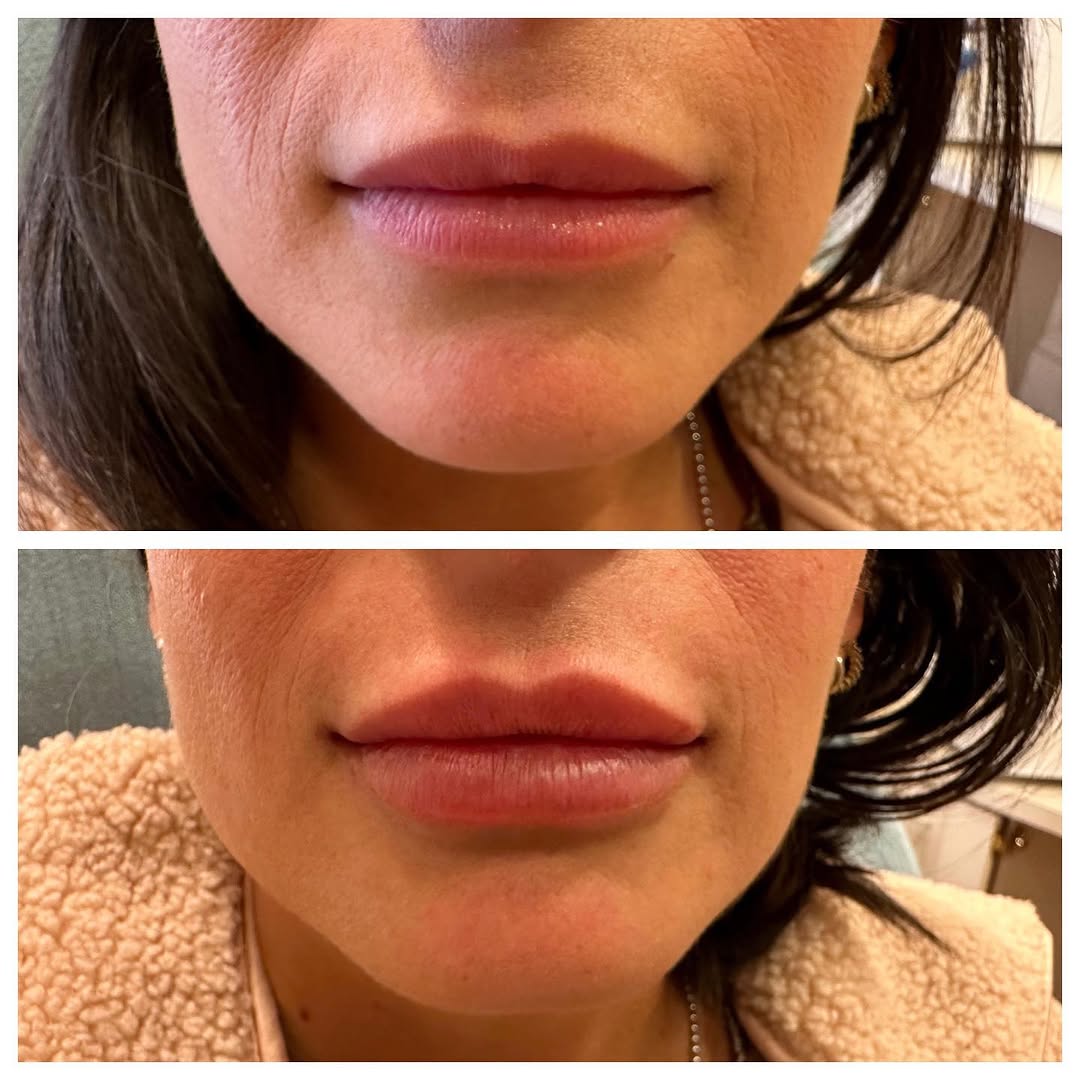 Instagram post by Dr. Richard L. Zeff: Beautiful lips done by our nurse injector Heather last week. 💋Client wanted a refresh. A little more volume and some hydration. She was ver…