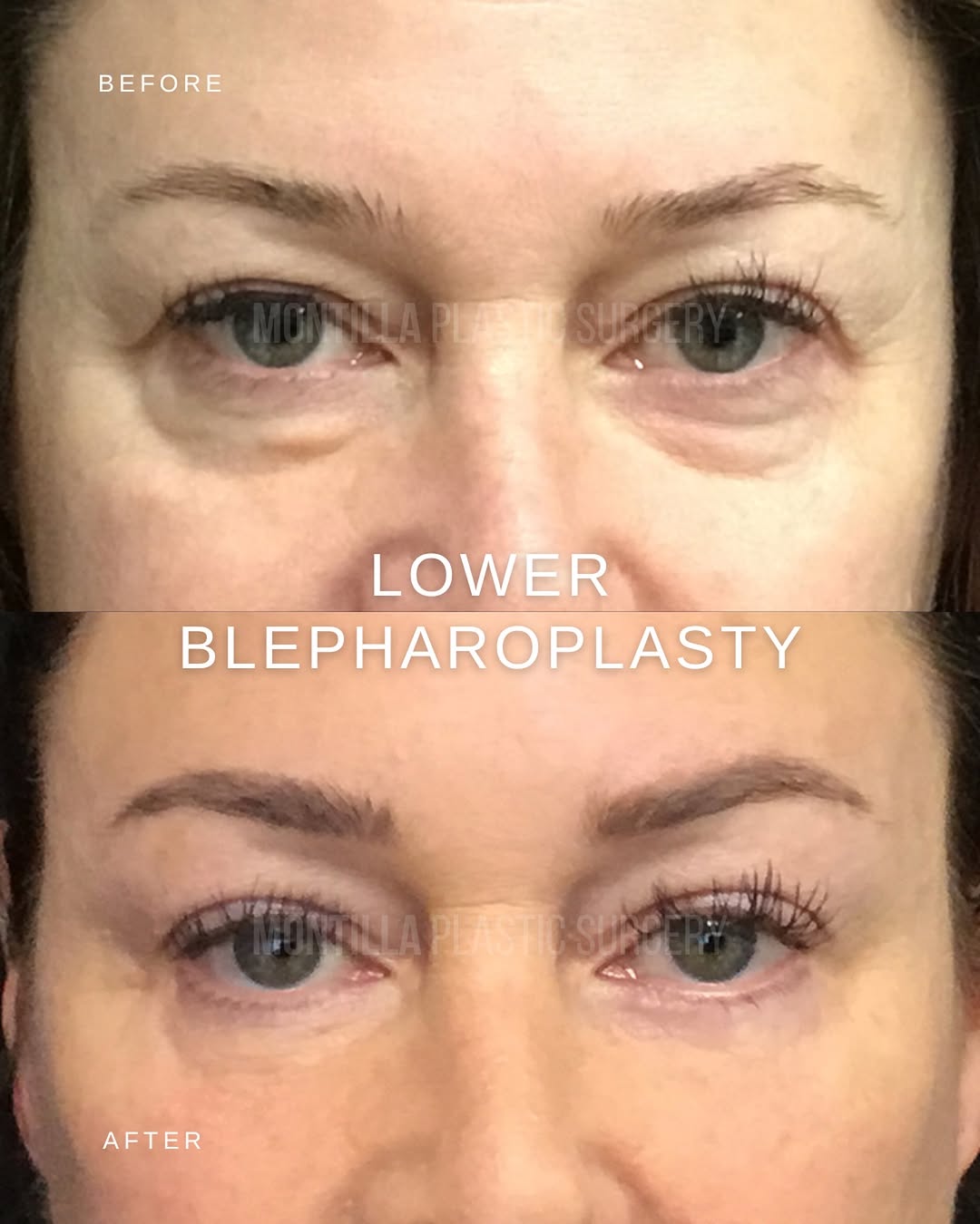 Instagram post by Dr. Richard Montilla: This patient underwent lower #blepharoplasty, a surgical procedure designed to address excess skin, fat, or puffiness beneath the eyes. Lowe…