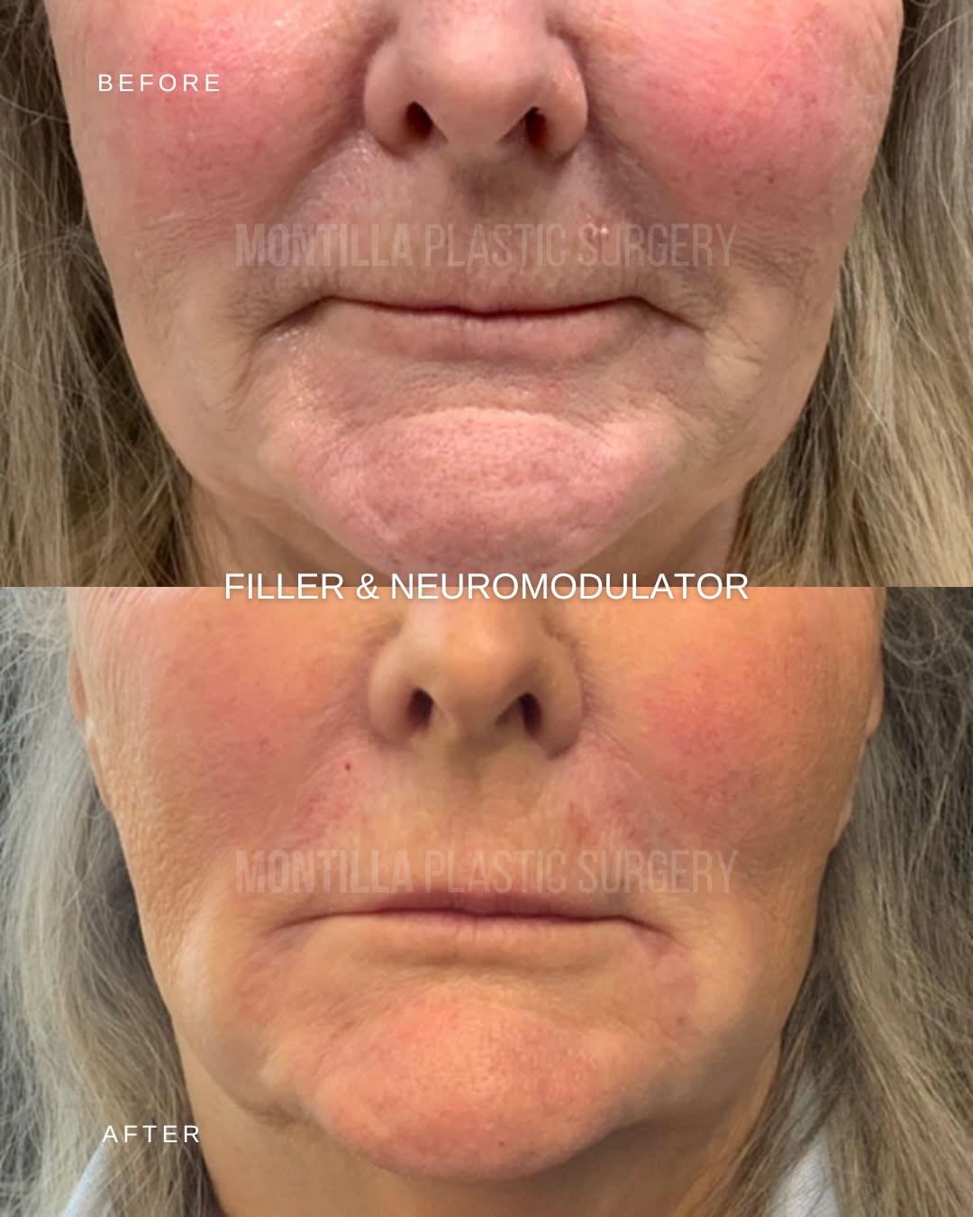 Instagram post by Dr. Richard Montilla: Scroll through more refreshed & glowing version of our patients.✨ Neuromodulators soften expression lines by easing muscle tension. Dermal f…