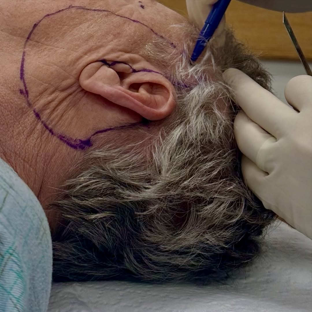 Instagram post by Dr. Richard Parfitt: Most people think a facelift begins with an incision. It doesn’t. It begins with a plan. Before surgery begins, Dr. Parfitt carefully maps e…