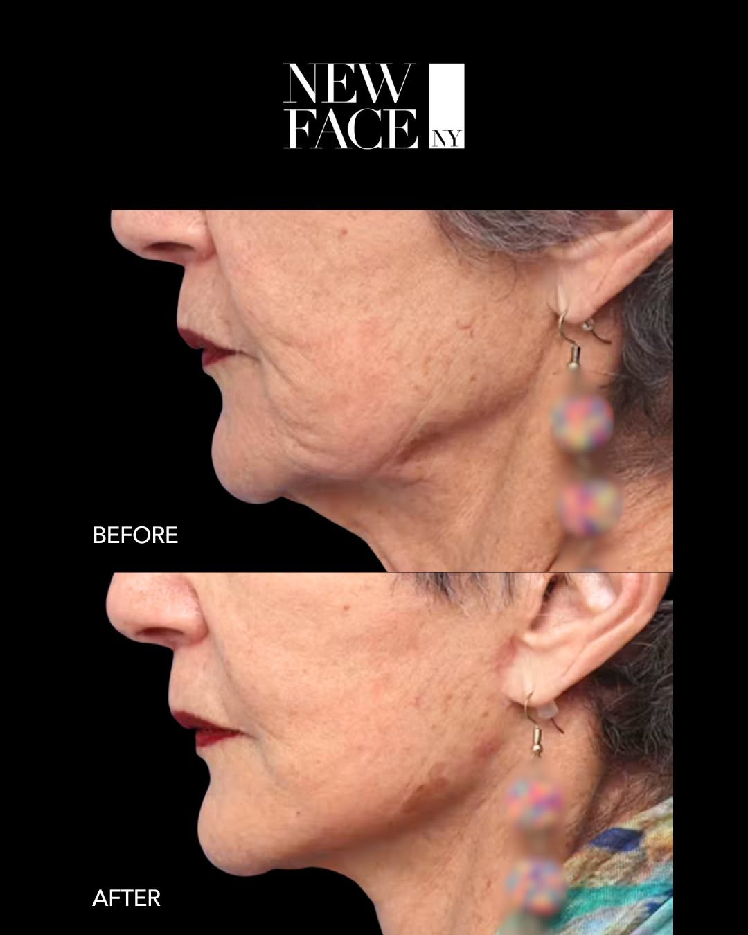 Instagram post by Dr. Richard W. Westreich: This is what 6 months of healing looks like after a deep plane facelift, necklift, and fat transfer. The deep plane approach repositions the…