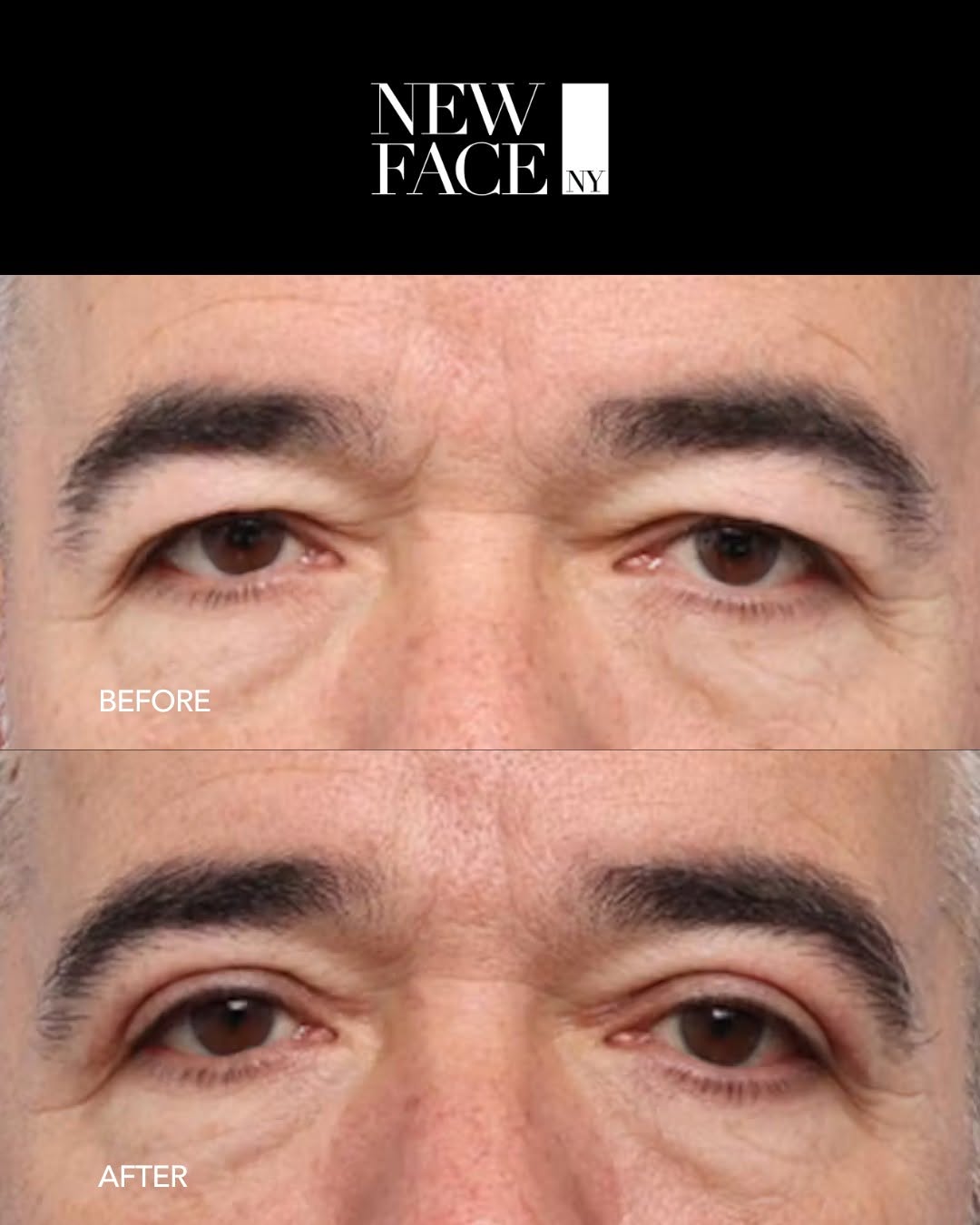 Instagram post by Dr. Richard W. Westreich: Upper eyelid lifts in men can be performed without creating a startled or unmanly result. When done correctly, an upper eyelid lift, paired …