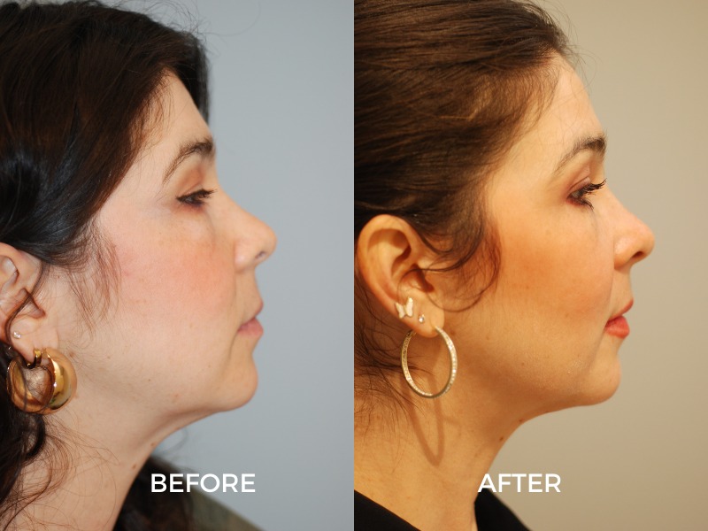 Instagram post by Dr. Richard Wellington Swift: Defined cheeks. Natural elegance. ✨ Buccal fat removal can help create a slimmer, more sculpted facial appearance by reducing fullness in th…