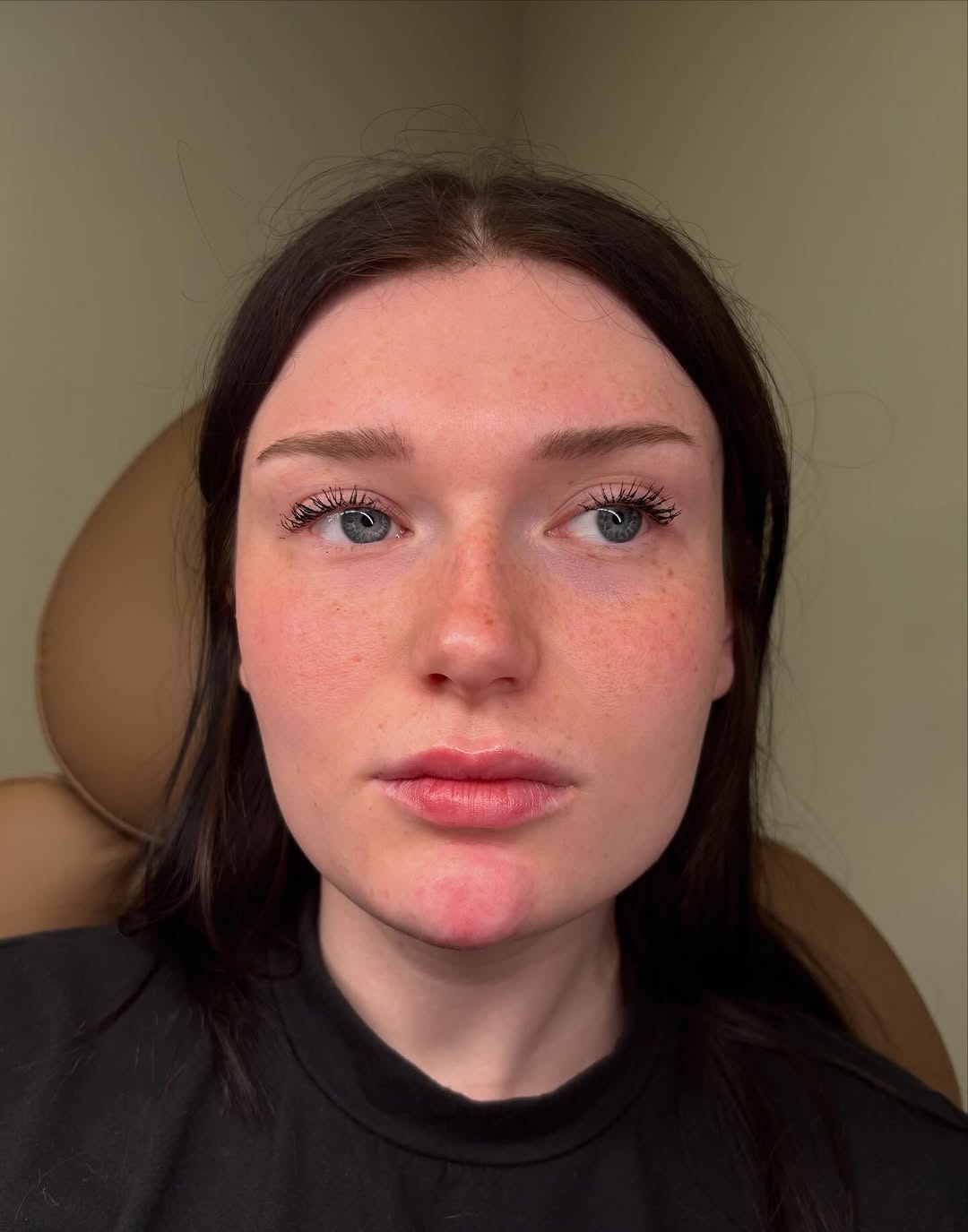 Instagram post by Dr. Rick J. Smith: This before-and-after was achieved over two appointments, using two syringes of Voluma total to enhance our patient’s chin and create a more…