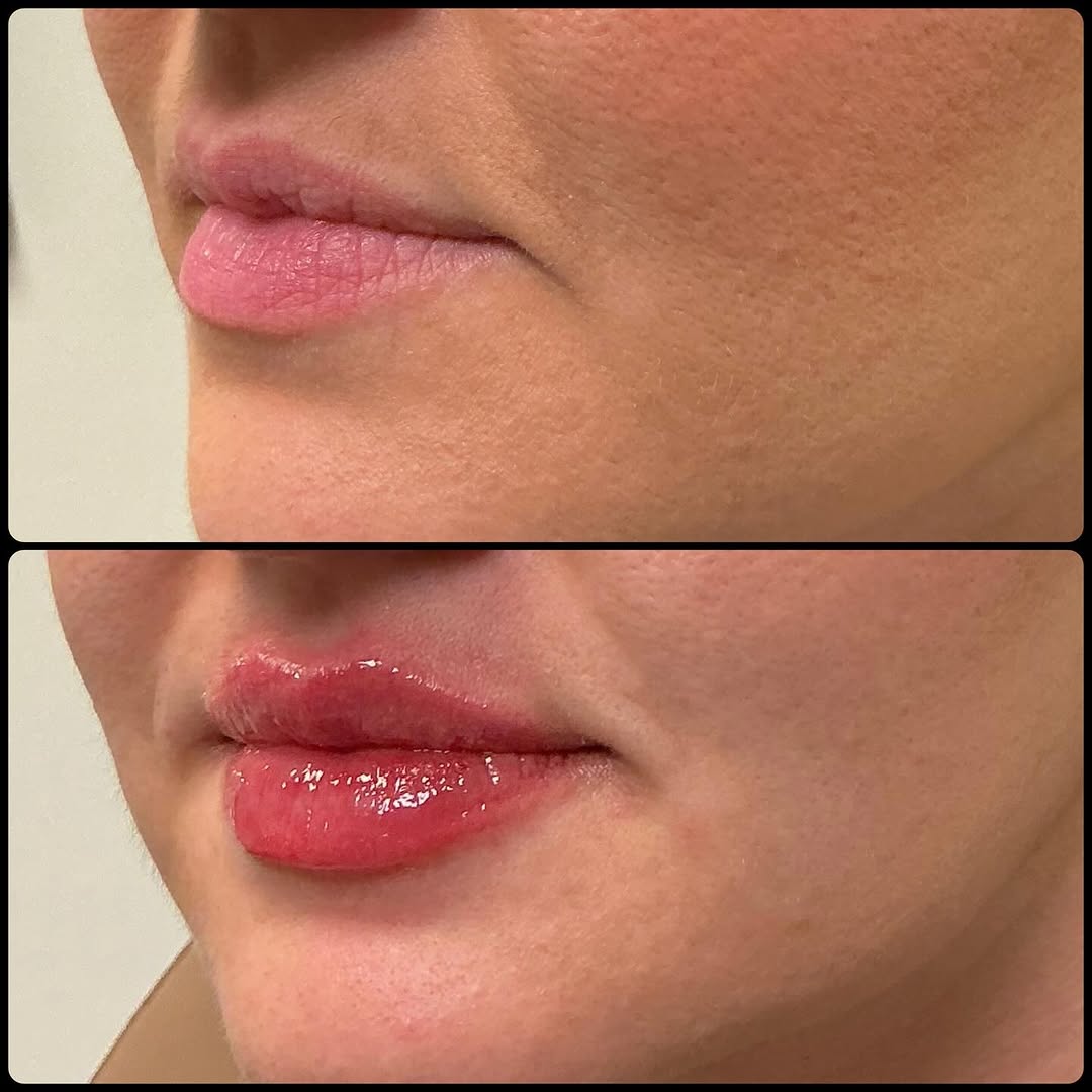 Instagram post by Dr. Rick J. Smith: Just 0.7 syringe of Restylane Kysse can make such a noticeable difference. This added subtle volume and an enhanced lip shape all while look…