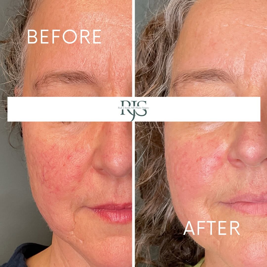 Instagram post by Dr. Rick J. Smith: Are you looking to reduce redness in your complexion? BBL HEROic® can be an effective tool for managing the visible signs of rosacea, reduci…