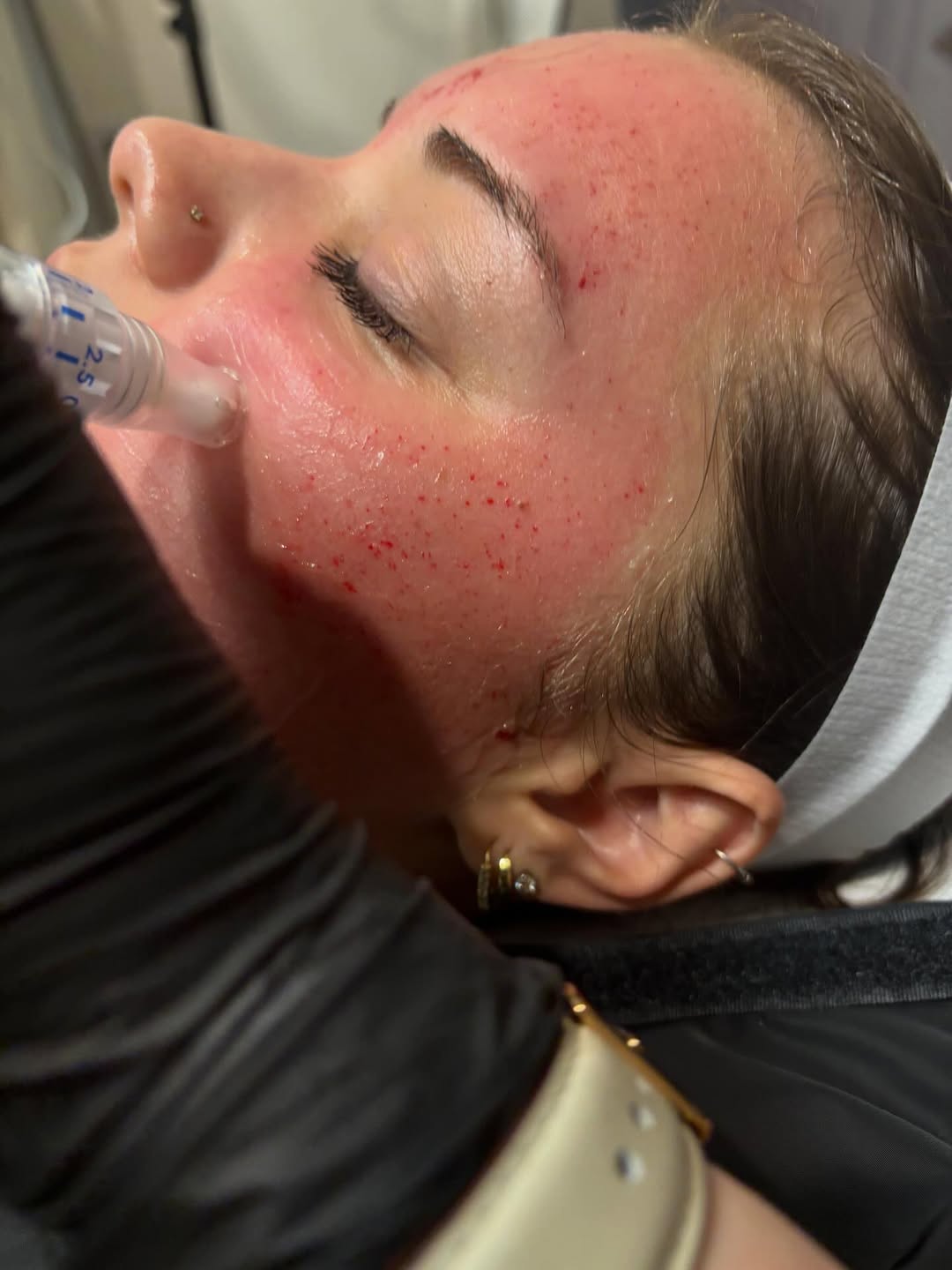 Instagram post by Dr. Rick J. Smith: End-of-Summer Skin Reset ☀️ As we transition into fall, it’s the perfect time to focus on restoring and rejuvenating your skin with micronee…
