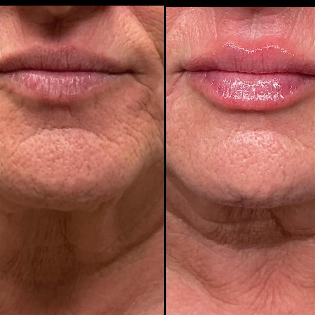 Instagram post by Dr. Rick J. Smith: One syringe of Restylane Kysse delivers a subtle, but beautiful difference. A little more volume, definition and shape while keeping the lip…
