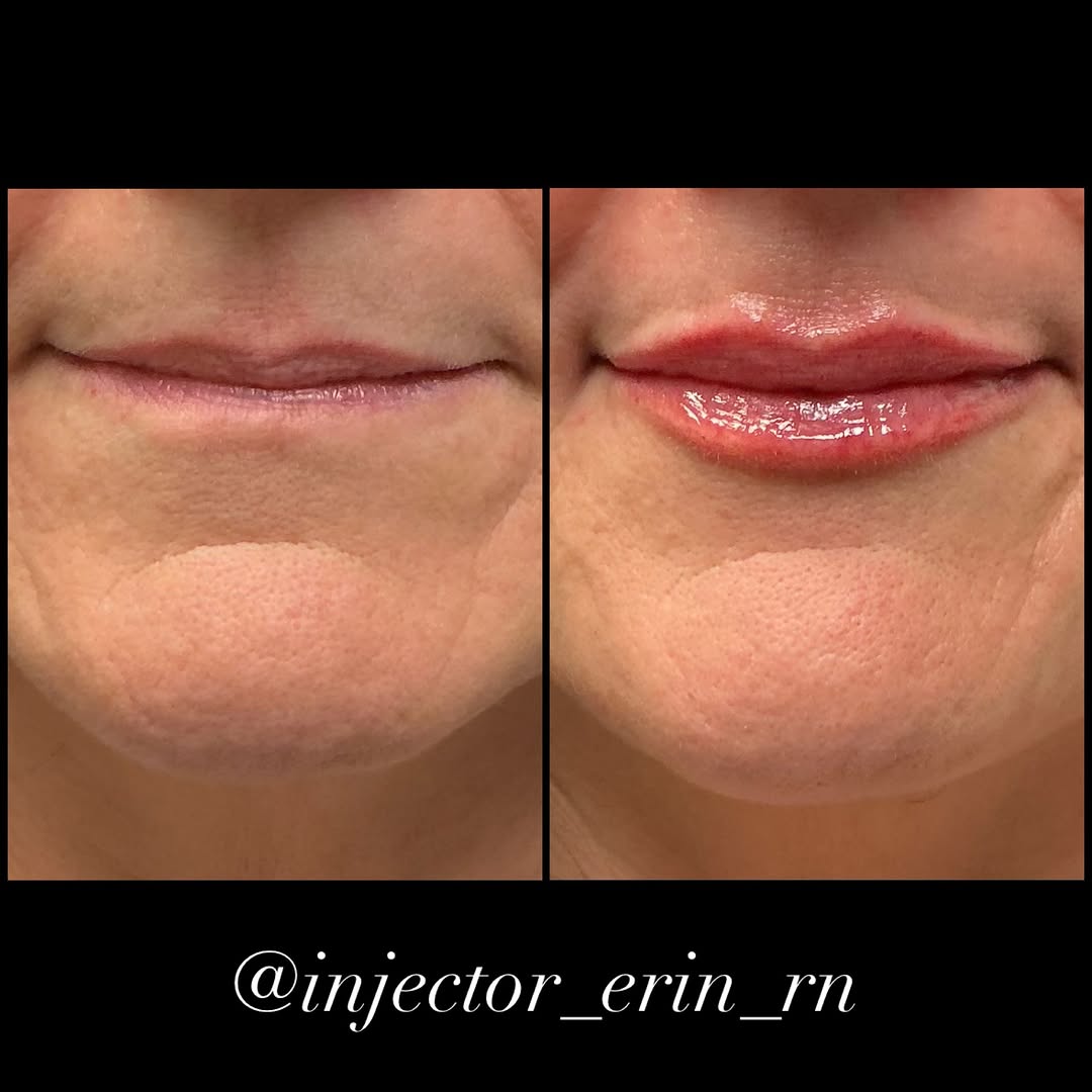 Instagram post by Dr. Rick J. Smith: #DermalFiller #LipFiller #NaturalResults #LipsByErin #ErinRN