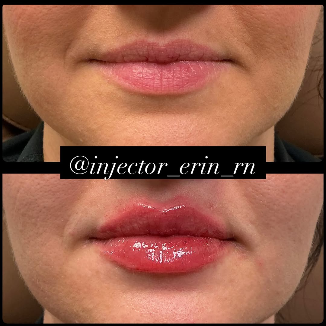 Instagram post by Dr. Rick J. Smith: #LipFiller #DermalFiller #PerfectPout #LipsByErin #ErinRN