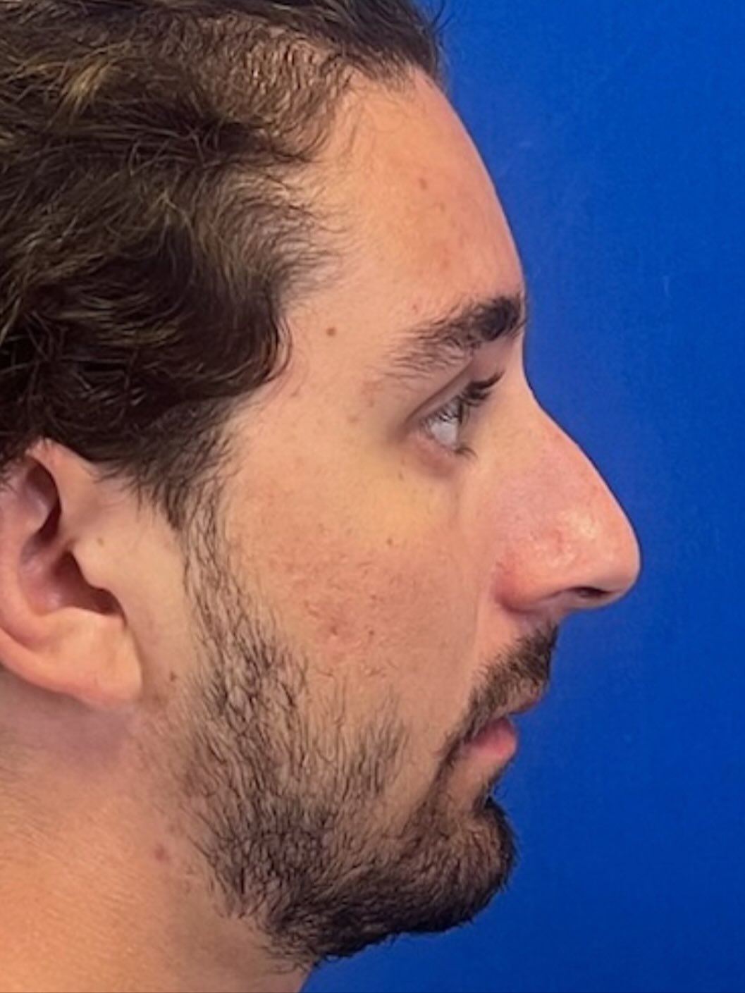Instagram post by Dr. Ricky Sayal, DO: Rhinoplasty before and after result👃 #ent #cfps #rhinoplasty #nosejob #nosejobbeforeafter #earsnosethroat #michigan #bingham #novi
