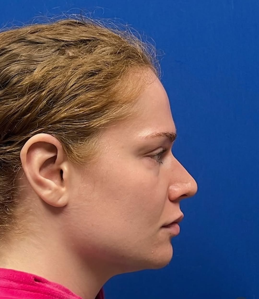 Instagram post by Dr. Ricky Sayal, DO: Finesse rhinoplasty- 5 month results! Thank you @drrickysayal for this wonderful transformation. #ent #specialist #ear #nose #throat #topdoc…