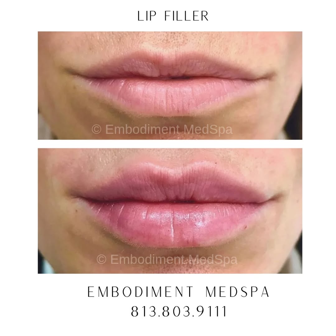 Instagram post by Dr. Rigo J. Mendoza: Still time to get your lips done before the holidays! • • #juvedermtampa #restylanetampa #injectablestampa #fillerstampa #versatampa #lipfil…
