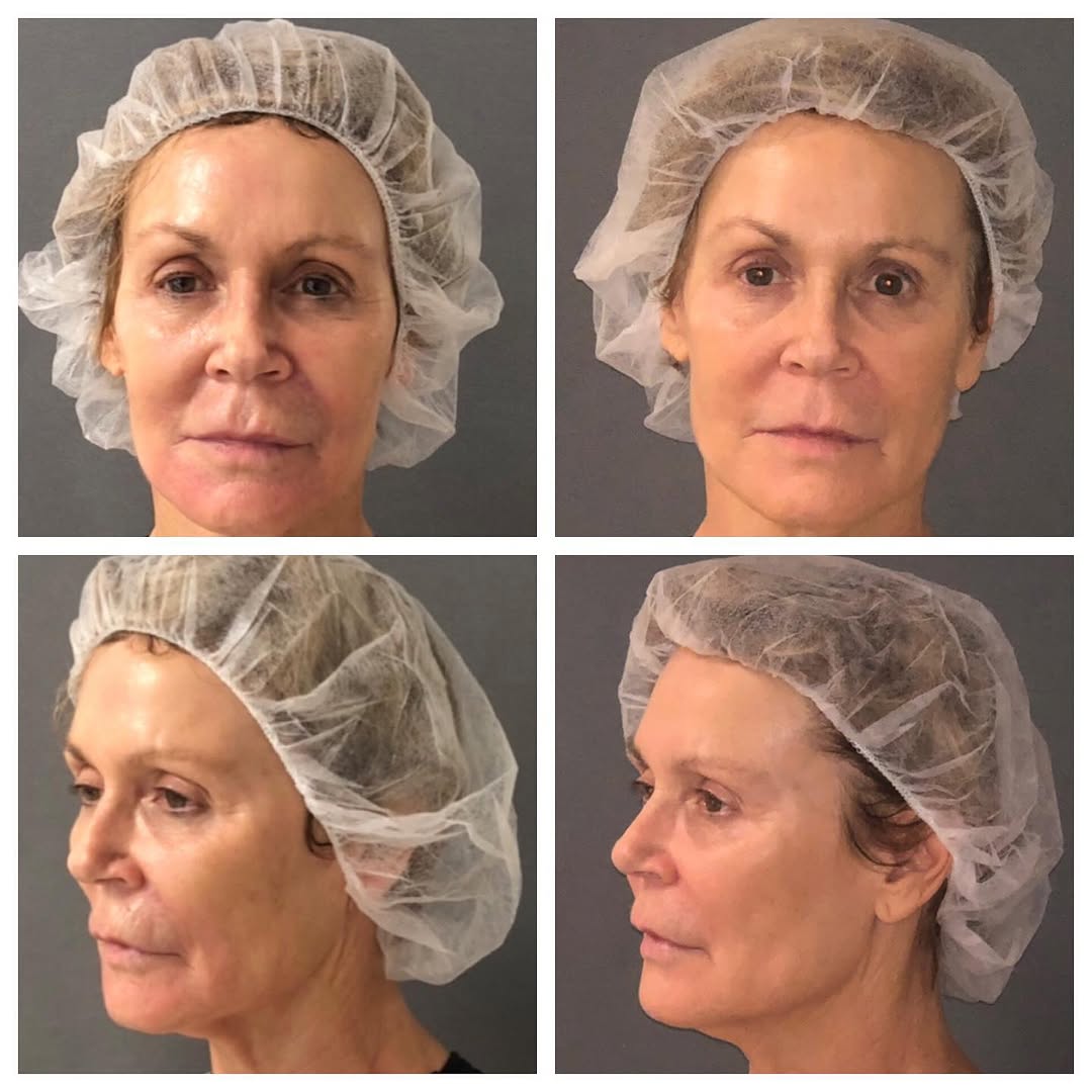 Instagram post by Dr. Robert B. Seltzer: This is after 2 treatments of a combo of Fractora and Morpheus8 by our great Registered Nurse, Karen. Photos to your left, are before treatm…