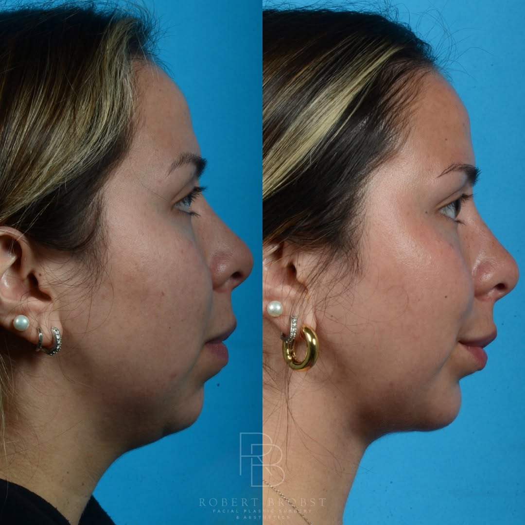 Instagram post by Dr. Robert Brobst: 💥Chin Implant & Neck Liposuction💥 This sweet patient was bothered by her jawline and neck contours for as long as she can remember. She ha…