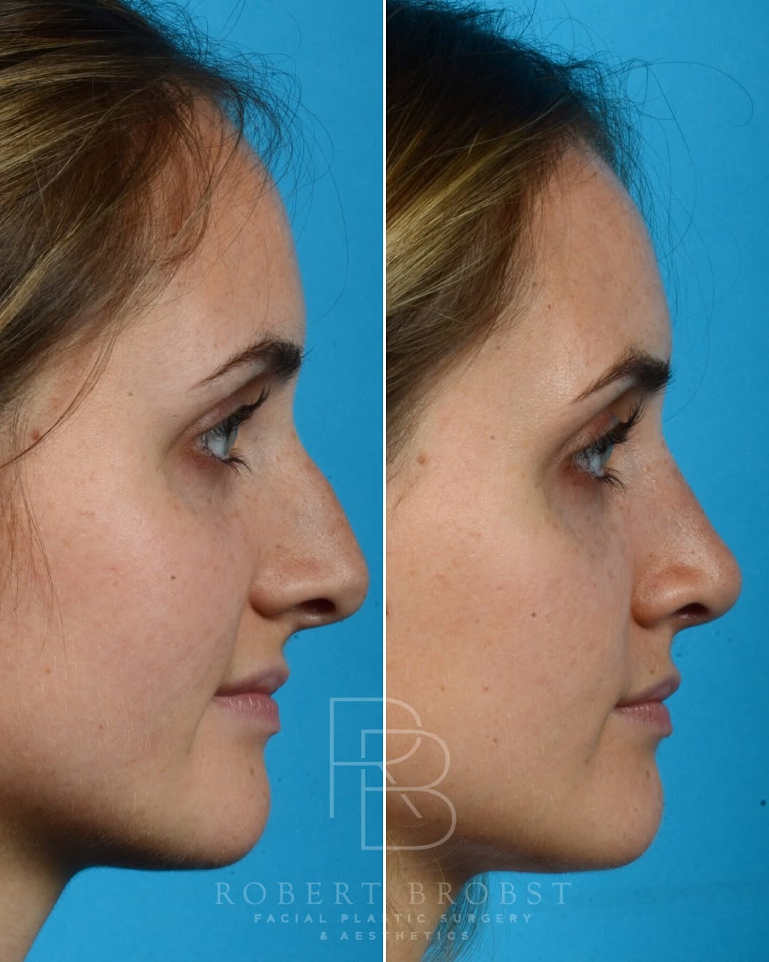 Instagram post by Dr. Robert Brobst: 💥RHINOPLASTY BEFORE & AFTER💥 This bright, confident collegiate was bothered by her nasal appearance for many years and finally found time …