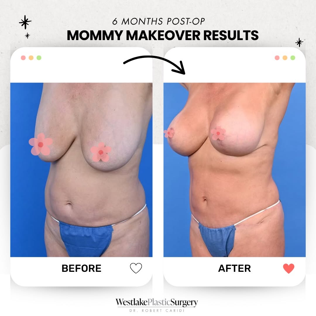 Instagram post by Dr. Robert Caridi: After pregnancy, she wanted to feel more like herself again- and a personalized mommy makeover helped her get there ✨ This patient had previ…