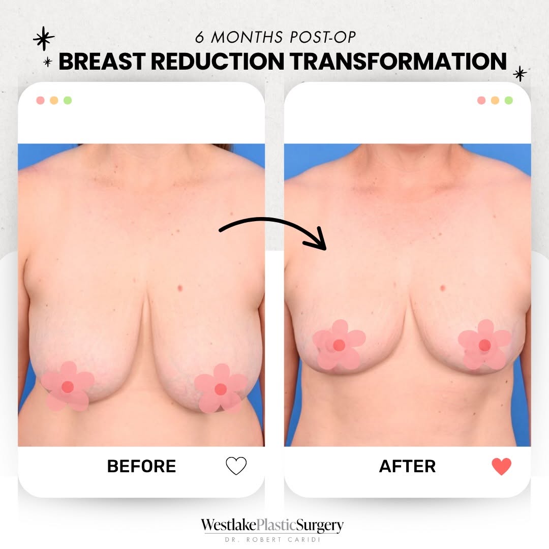 Instagram post by Dr. Robert Caridi: Now THIS is a breast reduction transformation ❤️🔥 450 grams removed from each breast, resulting in a smaller, lifted, more youthful shape …