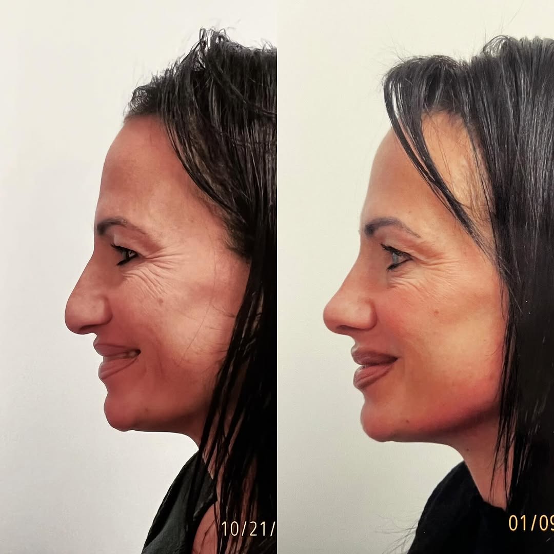 Instagram post by Dr. Robert Ciardullo: Pre and post op primary rhinoplasty Contact the office for a consultation with Robert Ciardullo (914) 761-8667 Website & location is in bio …