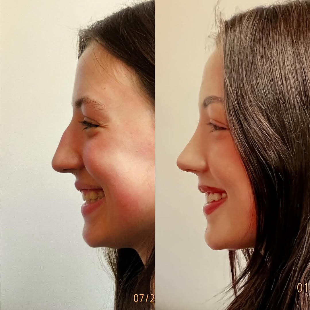 Instagram post by Dr. Robert Ciardullo: Pre and post op primary rhinoplasty Contact the office for a consultation with Robert Ciardullo (914) 761-8667 Website & location is in bio …
