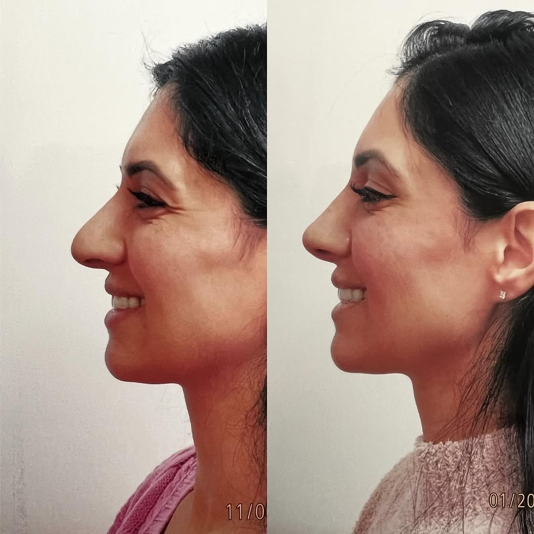 Instagram post by Dr. Robert Ciardullo: Pre and post op primary rhinoplasty Contact the office for a consultation with Robert Ciardullo (914) 761-8667 Website & location is in bio …