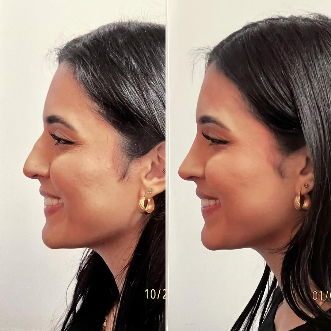 Instagram post by Dr. Robert Ciardullo: Pre and post op primary rhinoplasty Contact the office for a consultation with Robert Ciardullo (914) 761-8667 Website & location is in bio …