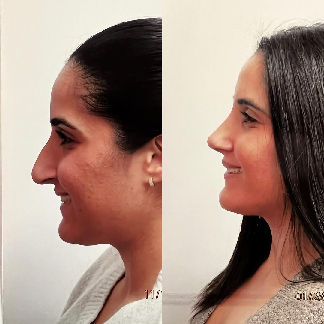 Instagram post by Dr. Robert Ciardullo: Pre and post op primary rhinoplasty Contact the office for a consultation with Robert Ciardullo (914) 761-8667 Website & location is in bio …