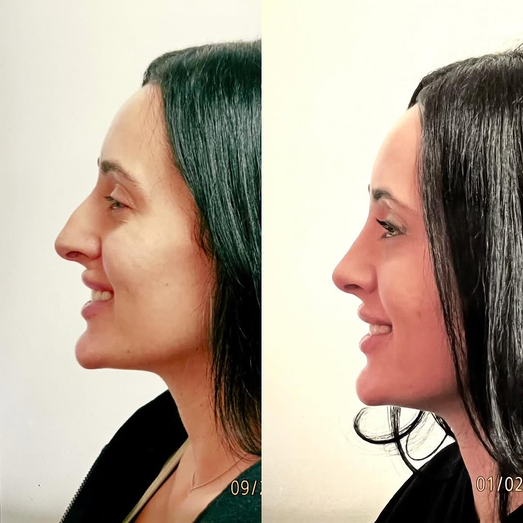 Instagram post by Dr. Robert Ciardullo: Pre and post op primary rhinoplasty Contact the office for a consultation with Robert Ciardullo (914) 761-8667 Website & location is in bio …