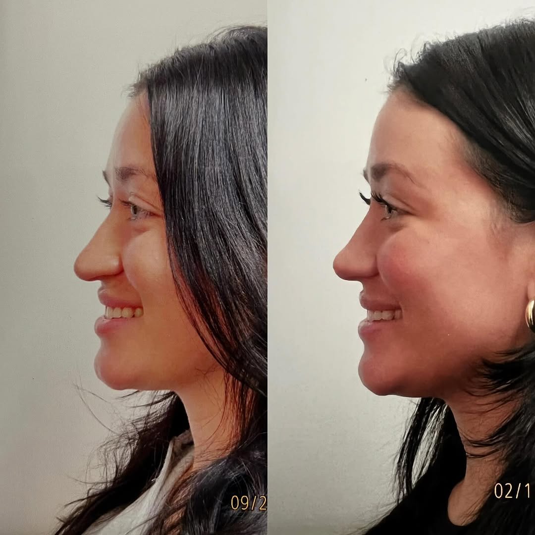 Instagram post by Dr. Robert Ciardullo: Pre and post op primary rhinoplasty Contact the office for a consultation with Robert Ciardullo (914) 761-8667 Website & location is in bio …