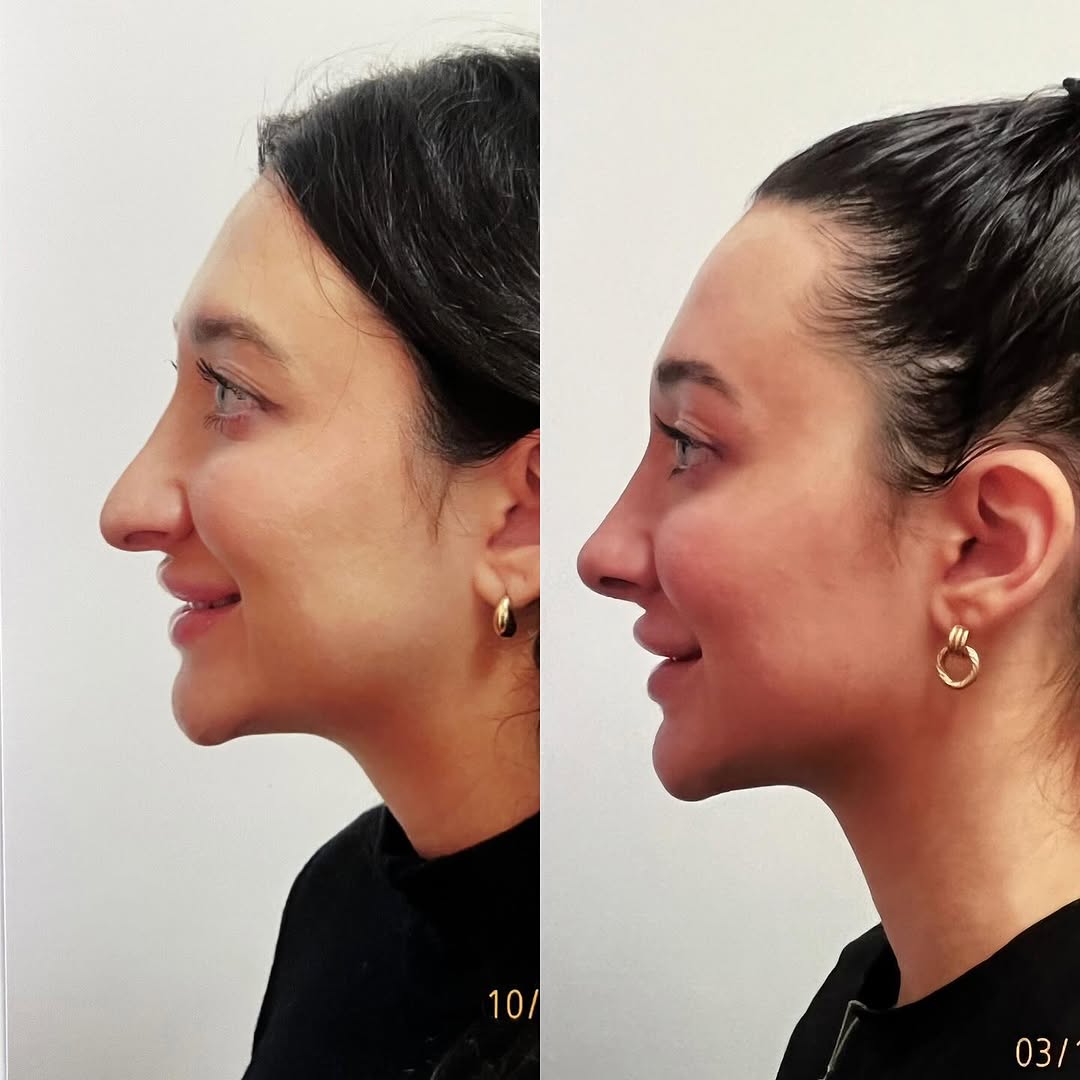 Instagram post by Dr. Robert Ciardullo: Pre and post op primary rhinoplasty Contact the office for a consultation with Robert Ciardullo (914) 761-8667 Website & location is in bio …