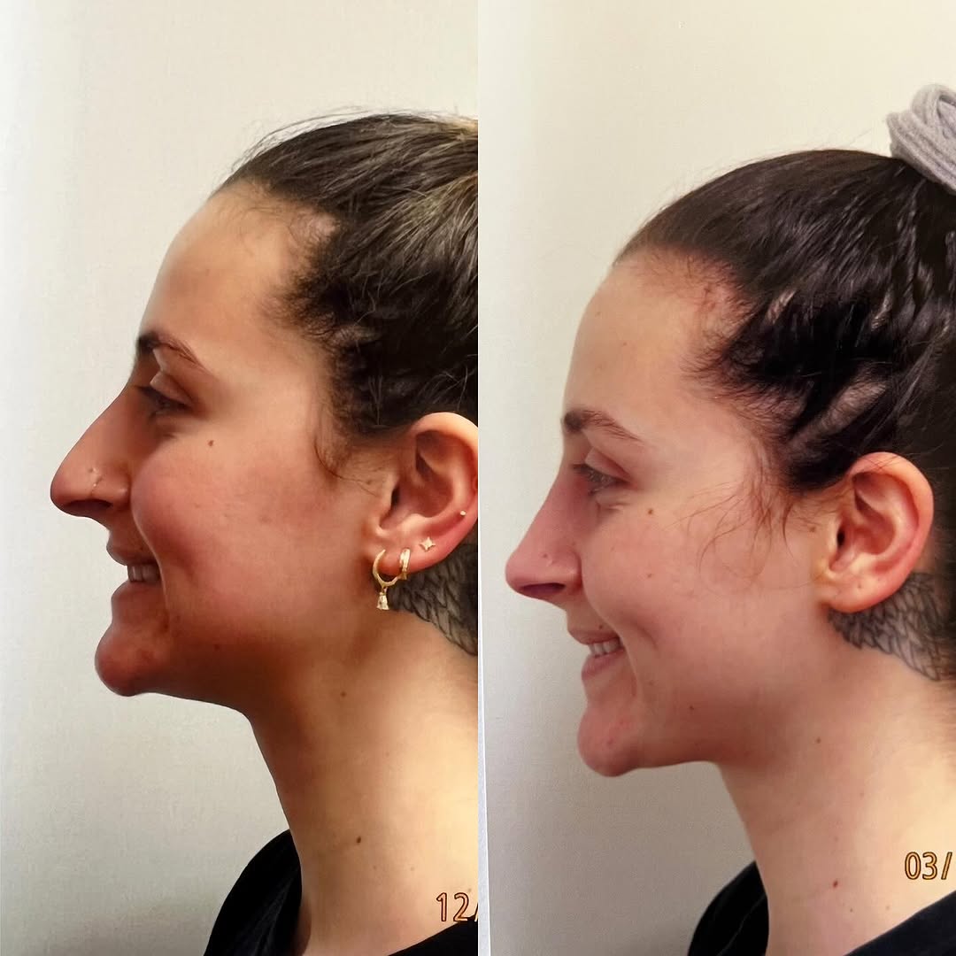 Instagram post by Dr. Robert Ciardullo: Pre and post op primary rhinoplasty Contact the office for a consultation with Robert Ciardullo (914) 761-8667 Website & location is in bio …