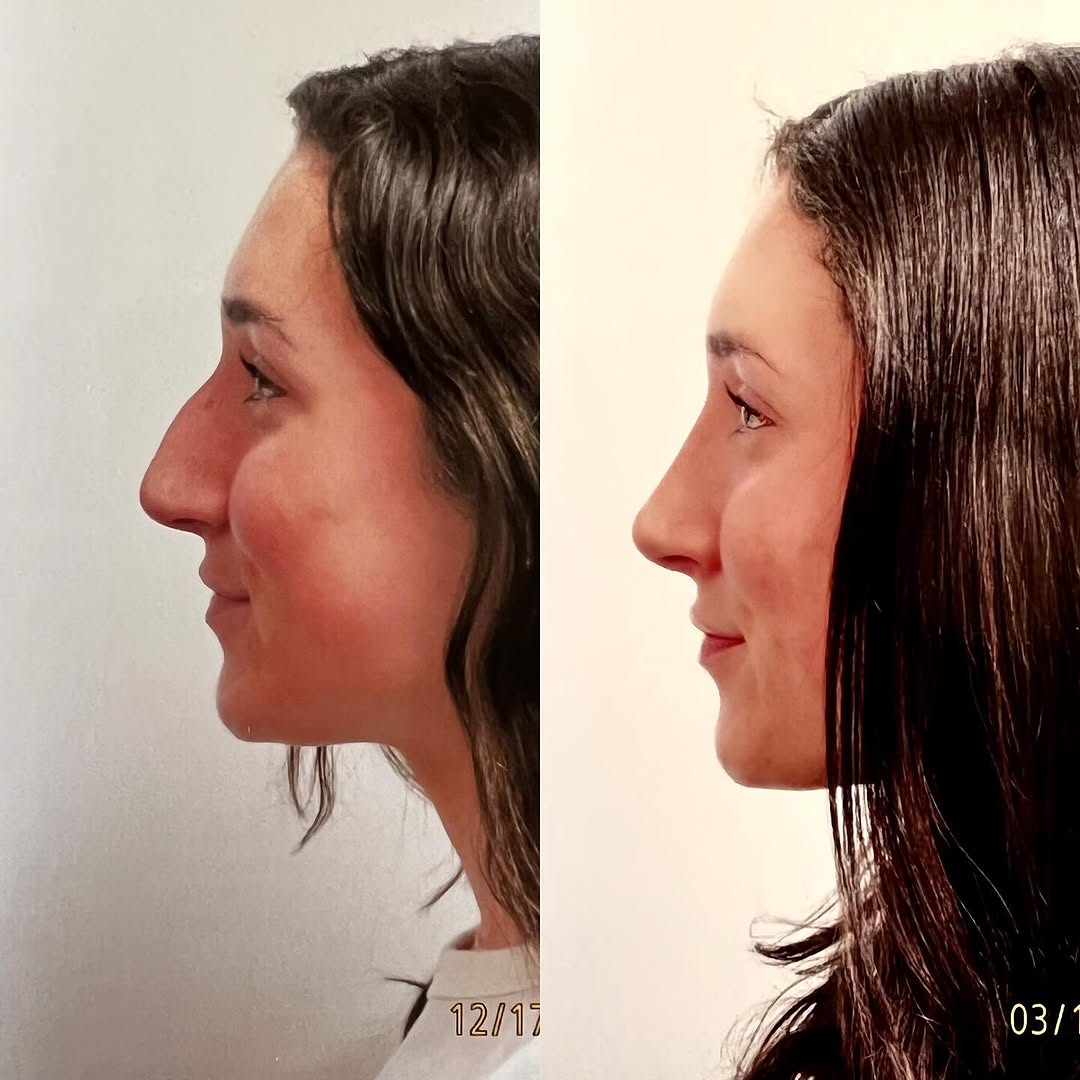 Instagram post by Dr. Robert Ciardullo: Pre and post op primary rhinoplasty Contact the office for a consultation with Robert Ciardullo (914) 761-8667 Website & location is in bio …