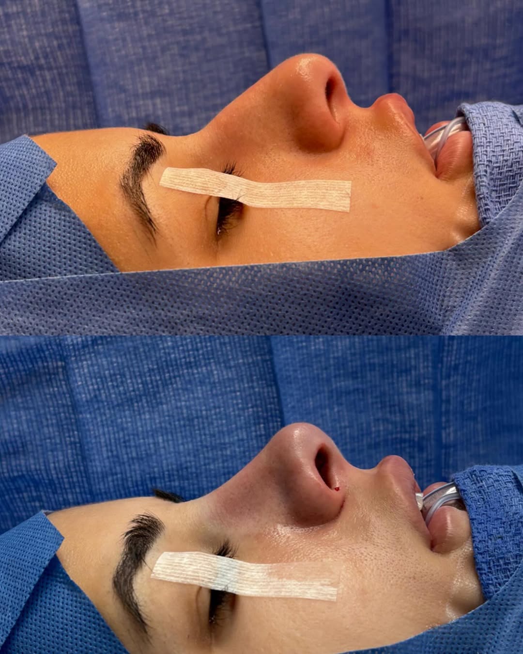 Instagram post by Dr. Robert Deeb: “On the table” before and after closed rhinoplasty result! Sometimes a subtle change can make a huge difference. Slight modification of the …