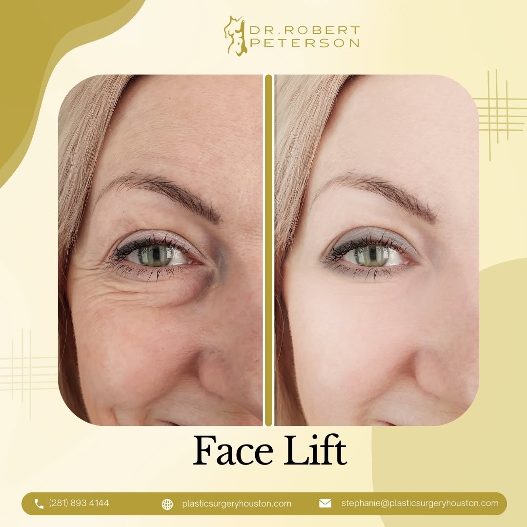Turn back the clock without losing your natural beauty! A face lift by Dr. Robert Peterson helps smooth lines, tighten skin, and refresh your appearance—all while keeping you looking like you. It’s