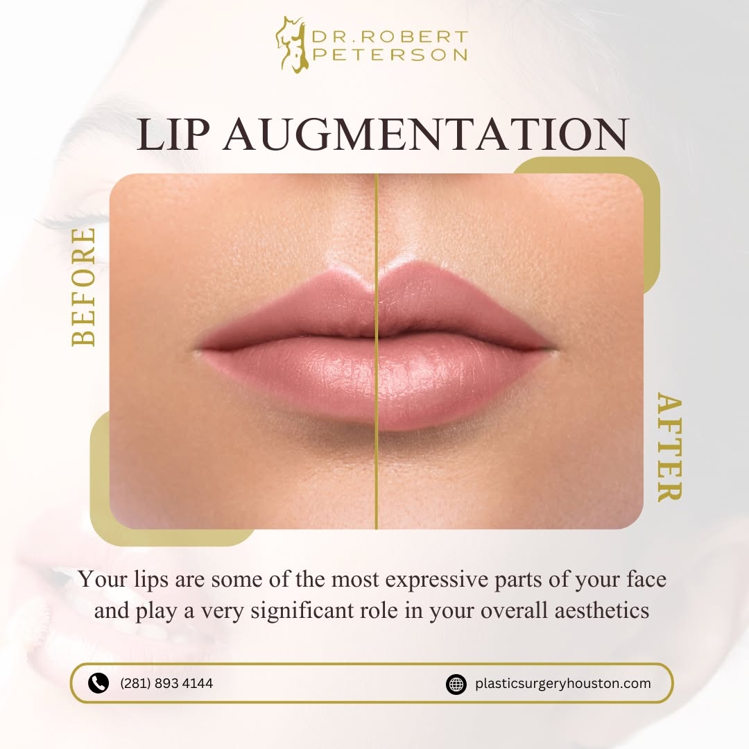Plump, natural, and oh-so-kissable! Lip augmentation by Dr. Robert Peterson gives you the fullness and shape you’ve always dreamed of. Subtle, stunning, and 100% you. Book your appointment with pla