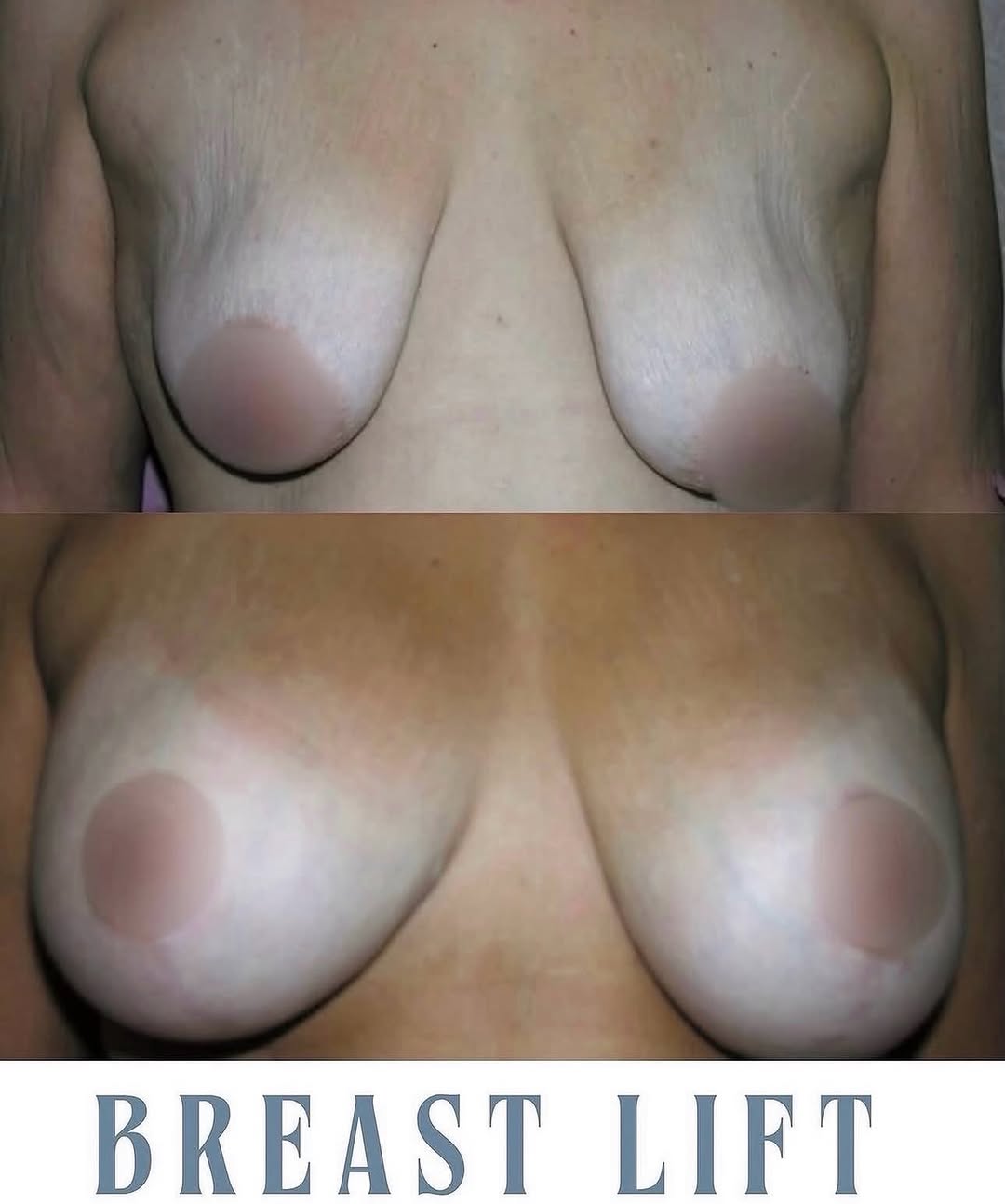 Instagram post by Dr. Robert E. Rothfield: A stunning breast lift transformation! ✨ These results are simply beautiful, giving her a renewed sense of confidence and comfort in her own…